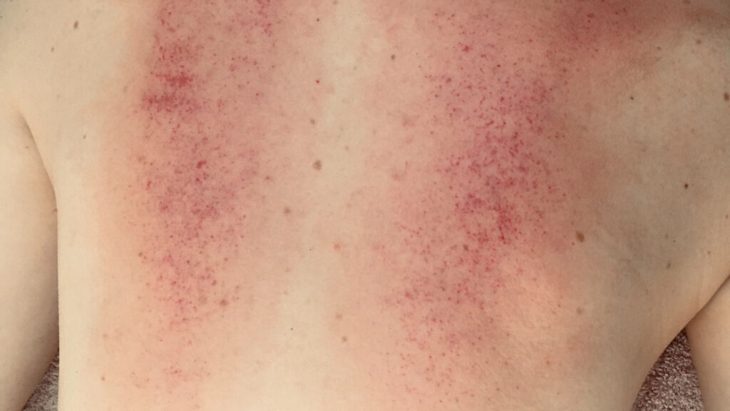 Primer plano de la espalda de una persona que muestra una erupción con numerosas pequeñas manchas rojas distribuidas por la piel después de un tratamiento con Gua Sha.